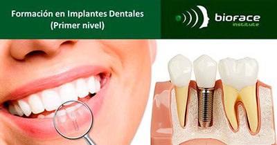 Formación en Implantes Dentales (Primer Nivel)